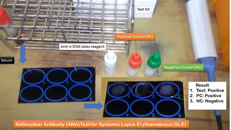 elisa test kis mein hota hai|ANA (Antinuclear Antibody) Test .